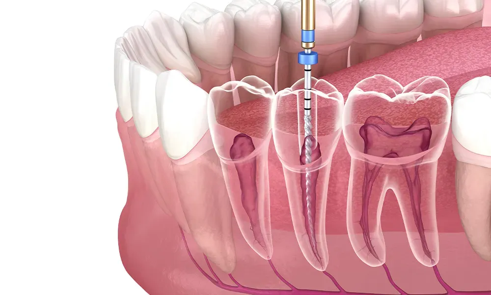 Can A Root Canal Procedure Save My Tooth?