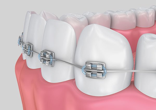 The Importance Of Orthodontic Treatments